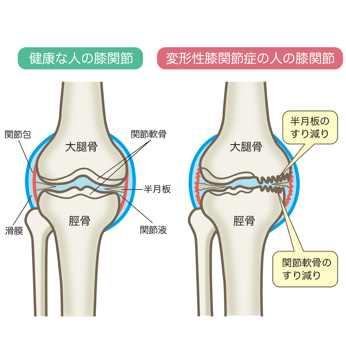 変形性膝関節症 | 佐藤整形外科医院 | 宮城県石巻市