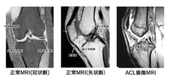靭帯損傷（内・外側側副靭帯、前・後十字靭帯損傷） | 佐藤整形外科 